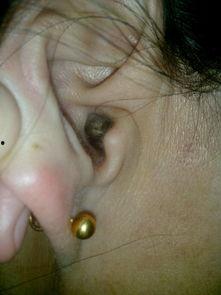 耳膜穿孔后，我让恶人伏法